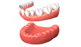 Los mejores precios en implantes dentales